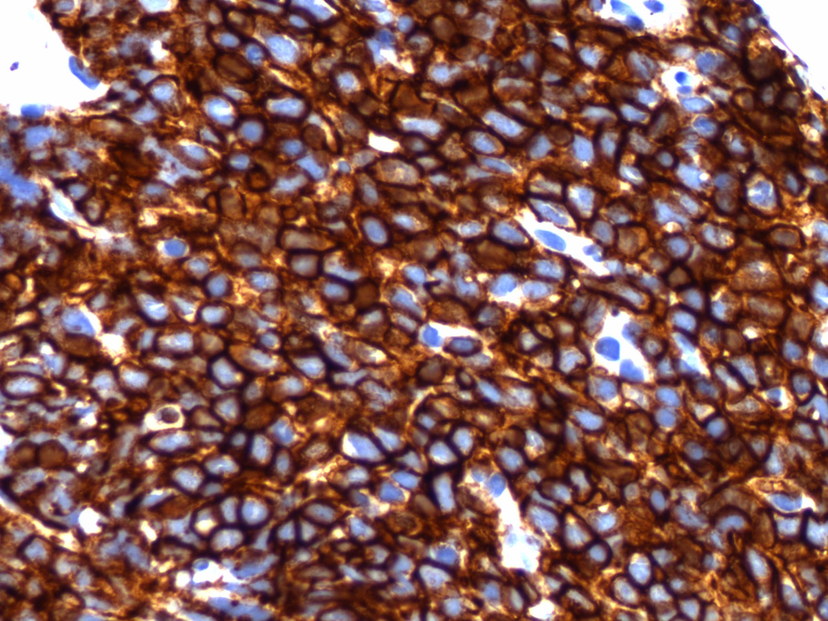 Immunohistochemical stain shows that the neoplastic cells are strongly positive for CD43 (400x).